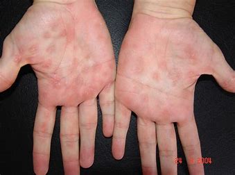 Infecciones de transmisión sexual