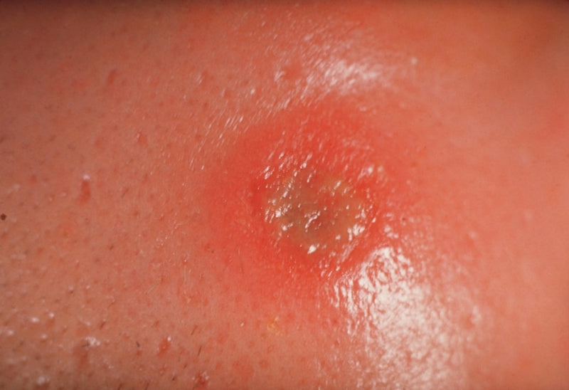 Syphilis