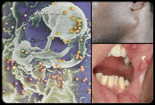 What is a STD (Sexually Transmitted Disease)?