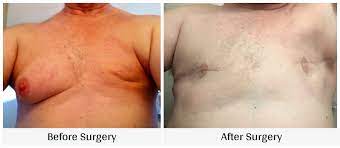 Breast Cancer Among Men