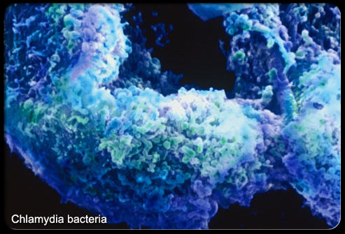 CHLAMYDIA  (NGU)
