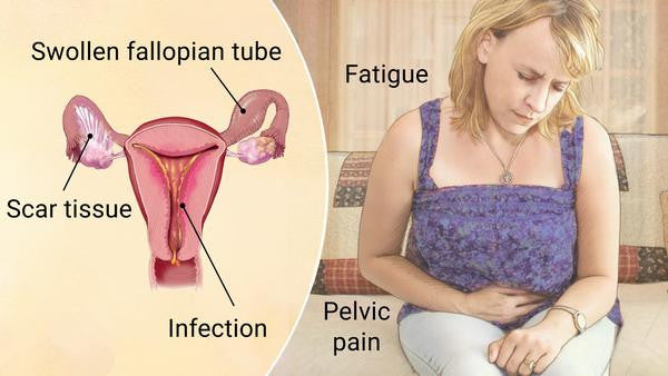 What Is Pelvic Inflammatory Disease?