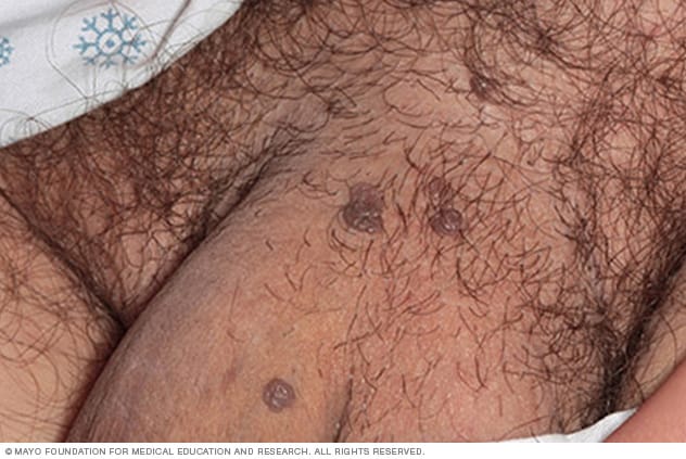 Genital Warts (HPV)