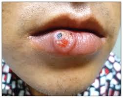 Syphilis