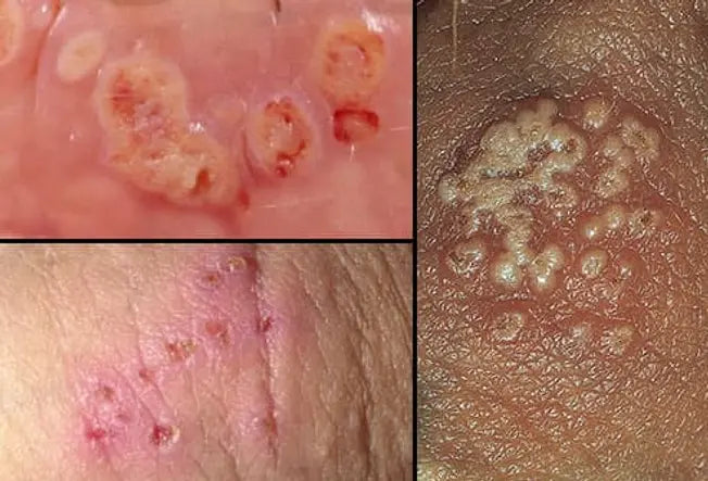 HERPES (Herpes Simplex) -Type 2